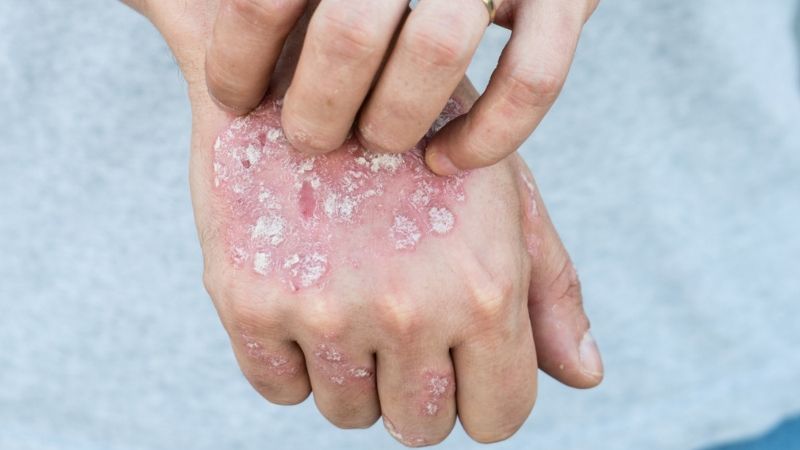Once Considered Rare, An Itchy Dermatologic Skin Disorder Is More Common Than Thought