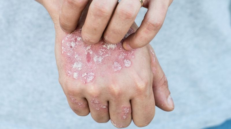 Once Considered Rare, An Itchy Dermatologic Skin Disorder Is More ...